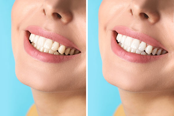 Cosmetic Dental Services With Natural Tooth Color from Smiley Dental in Maricopa, AZ