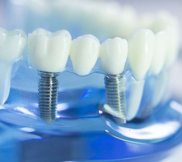 Maricopa Dental Implants