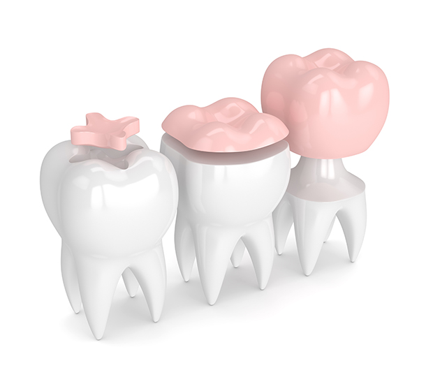 Maricopa Dental Inlays and Onlays