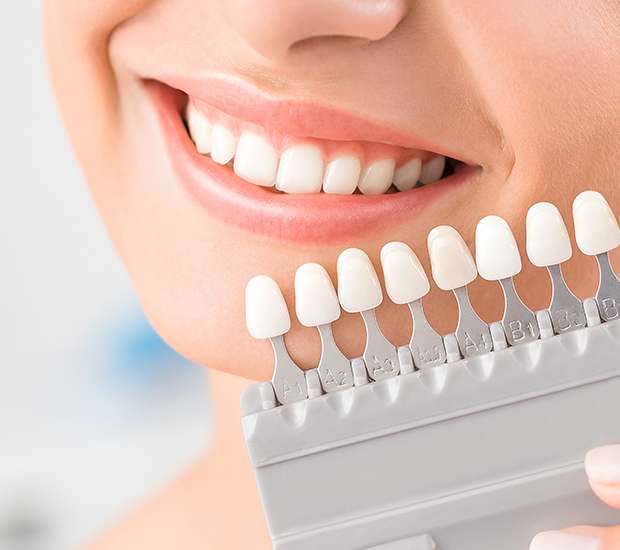 Maricopa Dental Veneers and Dental Laminates